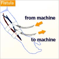 Fistula