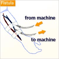Fistula